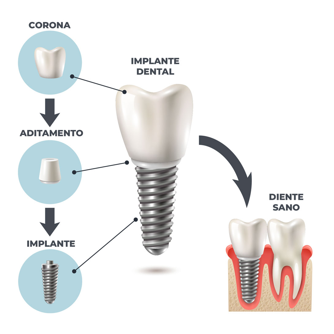 Implantes Dentales en Alcalá de Guadaíra Clínica Dental López Lora